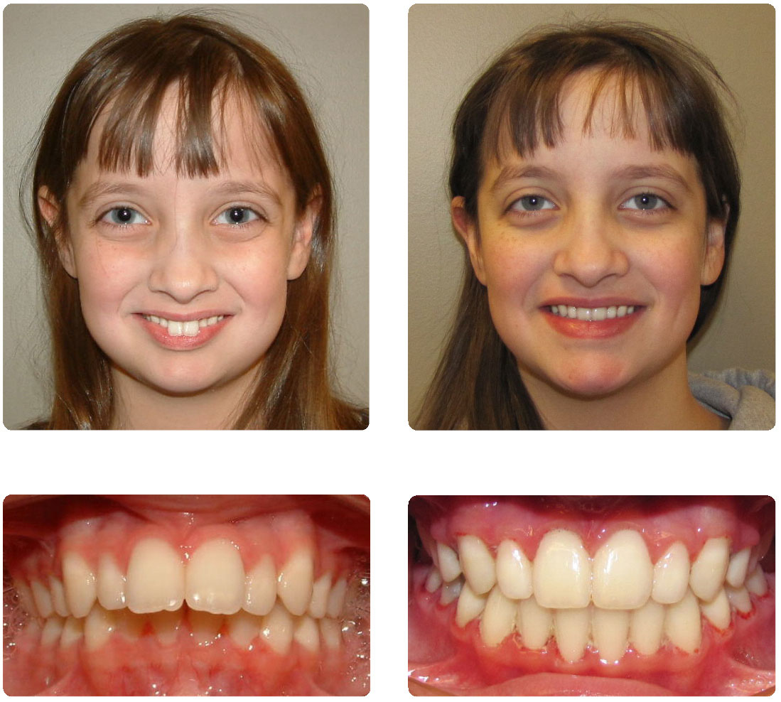 Before And After MO Smiles